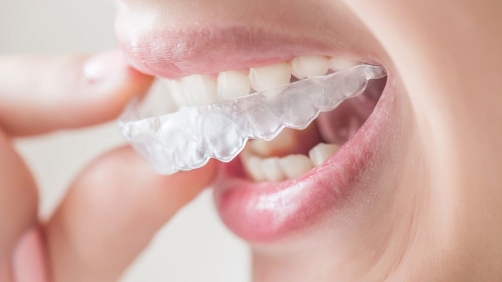 clear aligners australia